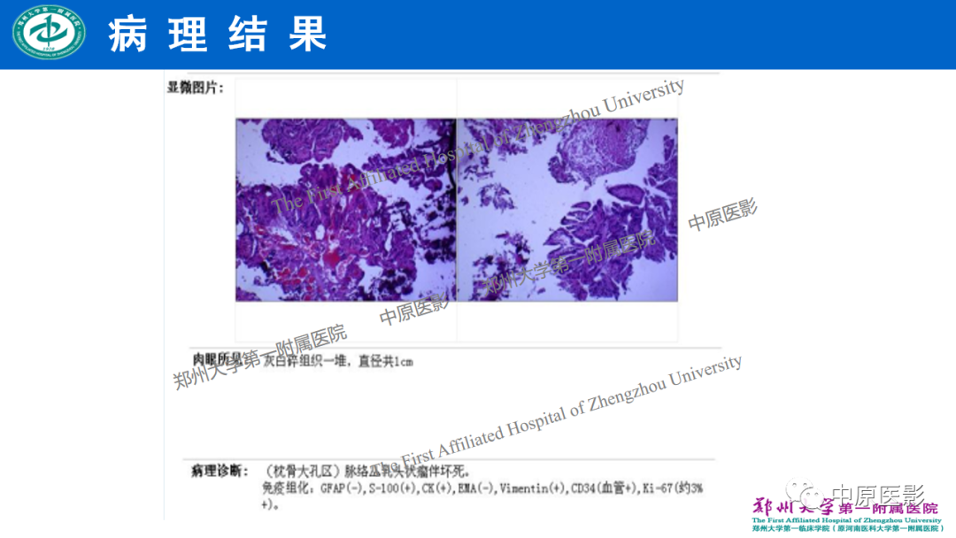 影像PPT - 【病例】枕骨大孔区脉络丛乳头状瘤1例MR影像-8