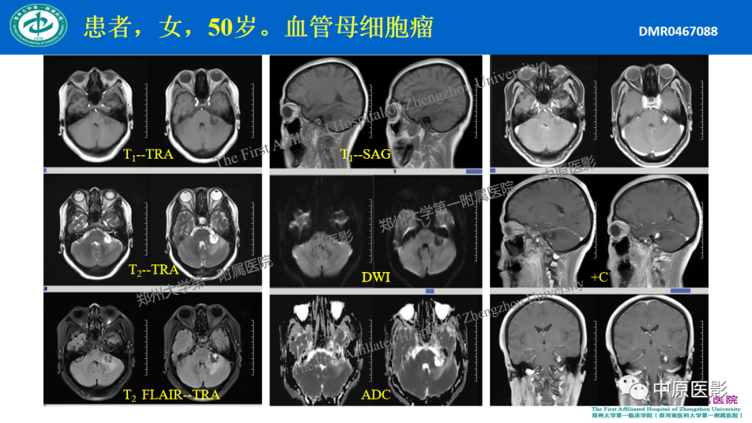 影像PPT - 【病例】枕骨大孔区脉络丛乳头状瘤1例MR影像-13
