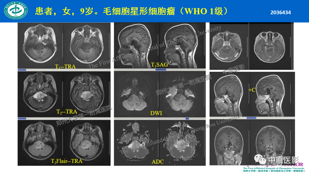 影像PPT - 【病例】枕骨大孔区脉络丛乳头状瘤1例MR影像-16