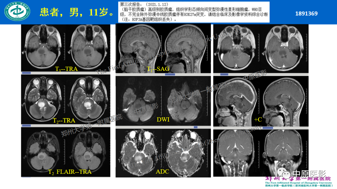 影像PPT - 【病例】枕骨大孔区脉络丛乳头状瘤1例MR影像-18