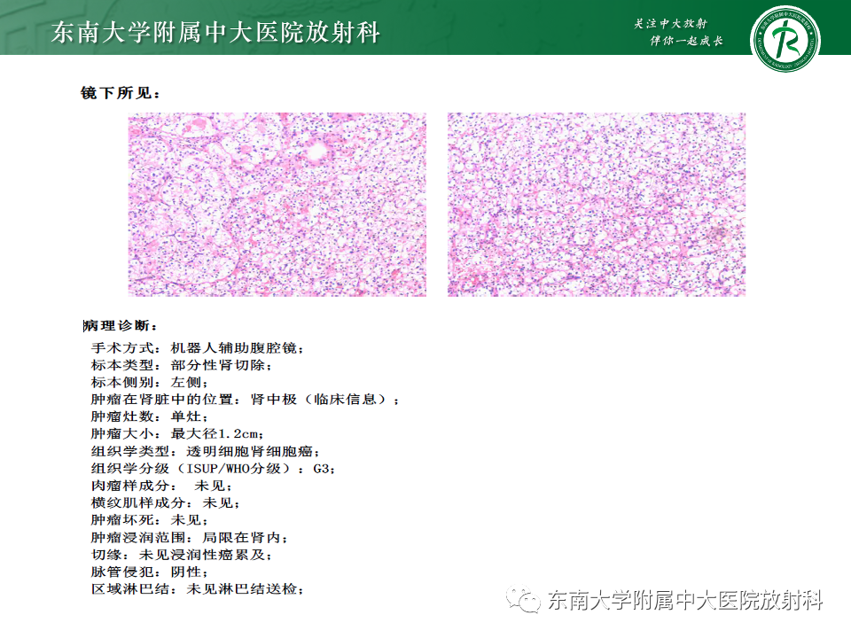 影像PPT - 【PPT】肾透明细胞癌-5
