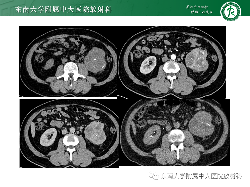 影像PPT - 【PPT】肾透明细胞癌-7