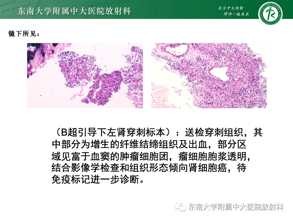 影像PPT - 【PPT】肾透明细胞癌-8