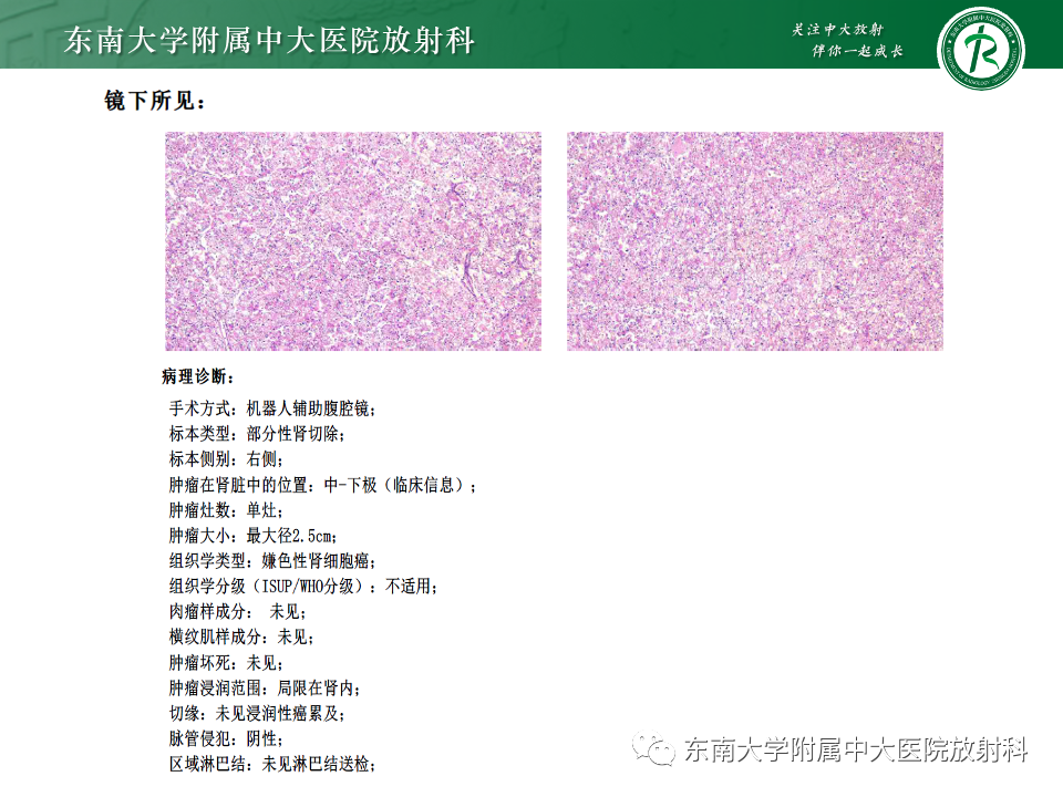 影像PPT - 【PPT】肾透明细胞癌-15