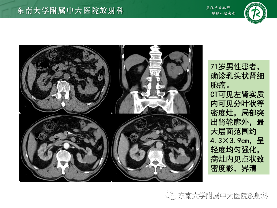 影像PPT - 【PPT】肾透明细胞癌-20