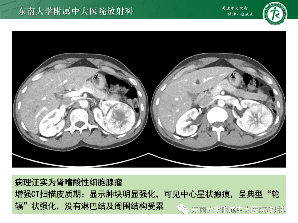 影像PPT - 【PPT】肾透明细胞癌-23