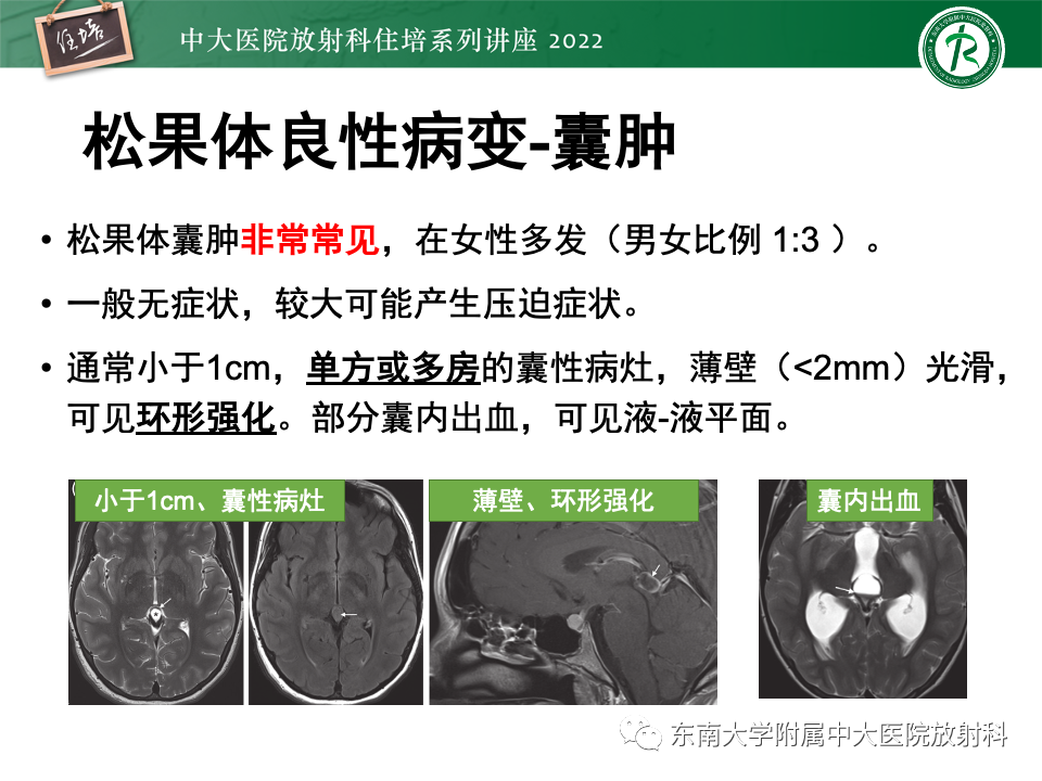 影像PPT - 【PPT】松果体区占位性病变的诊断思路-4