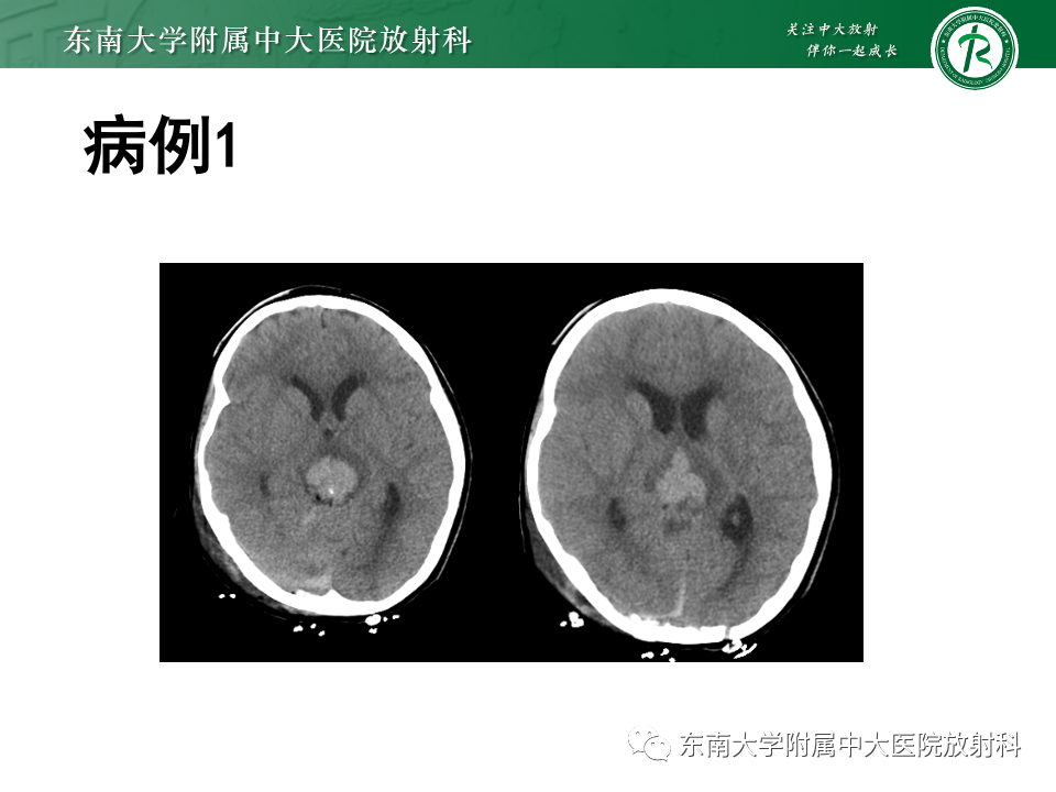 影像PPT - 【PPT】松果体区占位性病变的诊断思路-9