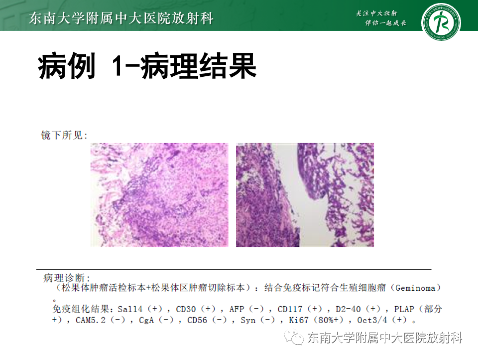 影像PPT - 【PPT】松果体区占位性病变的诊断思路-11