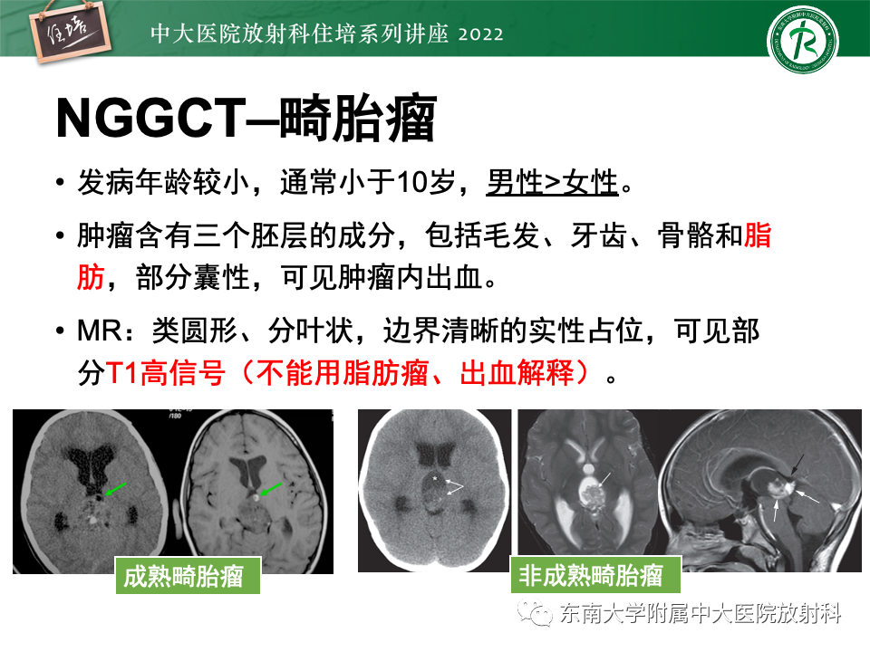 影像PPT - 【PPT】松果体区占位性病变的诊断思路-19