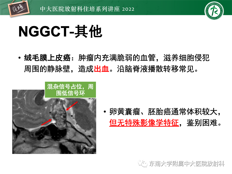 影像PPT - 【PPT】松果体区占位性病变的诊断思路-20