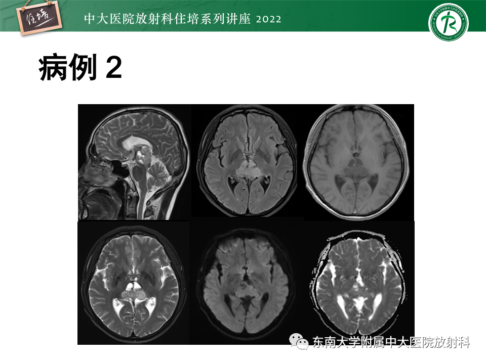 影像PPT - 【PPT】松果体区占位性病变的诊断思路-22