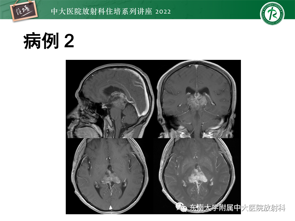 影像PPT - 【PPT】松果体区占位性病变的诊断思路-23