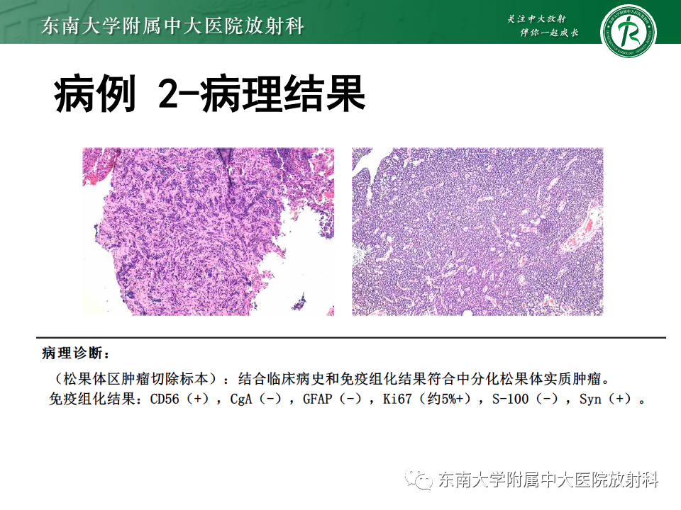 影像PPT - 【PPT】松果体区占位性病变的诊断思路-25