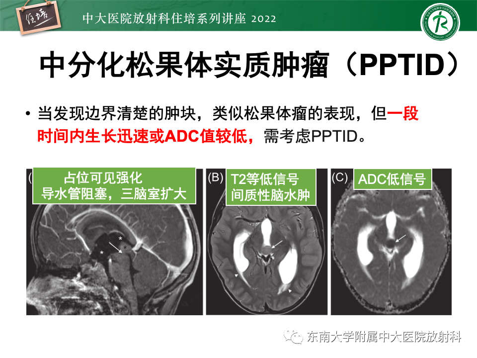 影像PPT - 【PPT】松果体区占位性病变的诊断思路-31