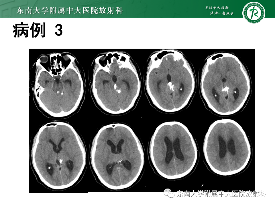 影像PPT - 【PPT】松果体区占位性病变的诊断思路-33