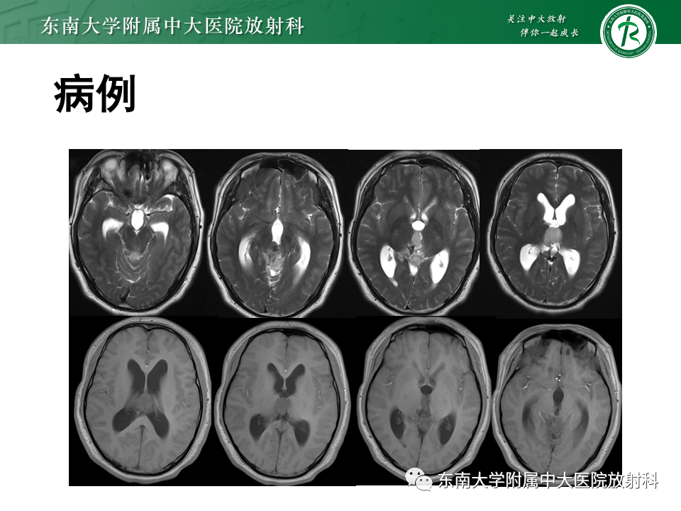 影像PPT - 【PPT】松果体区占位性病变的诊断思路-35
