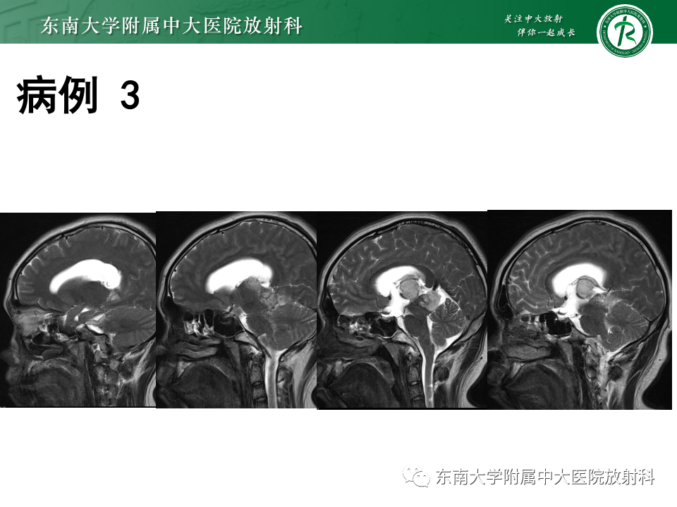 影像PPT - 【PPT】松果体区占位性病变的诊断思路-34