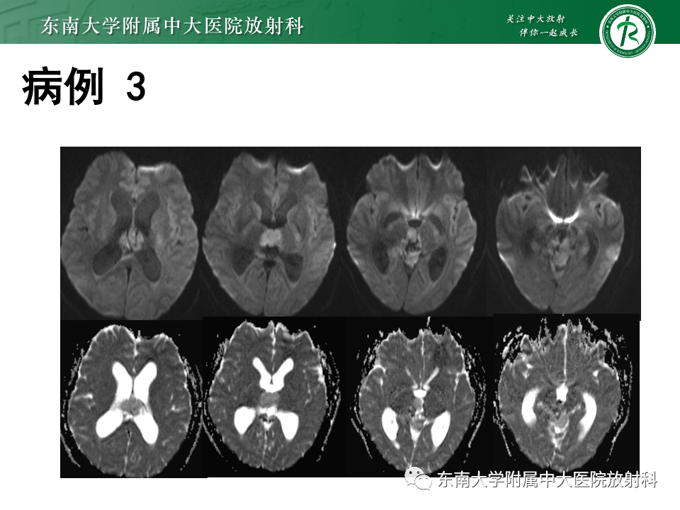影像PPT - 【PPT】松果体区占位性病变的诊断思路-36