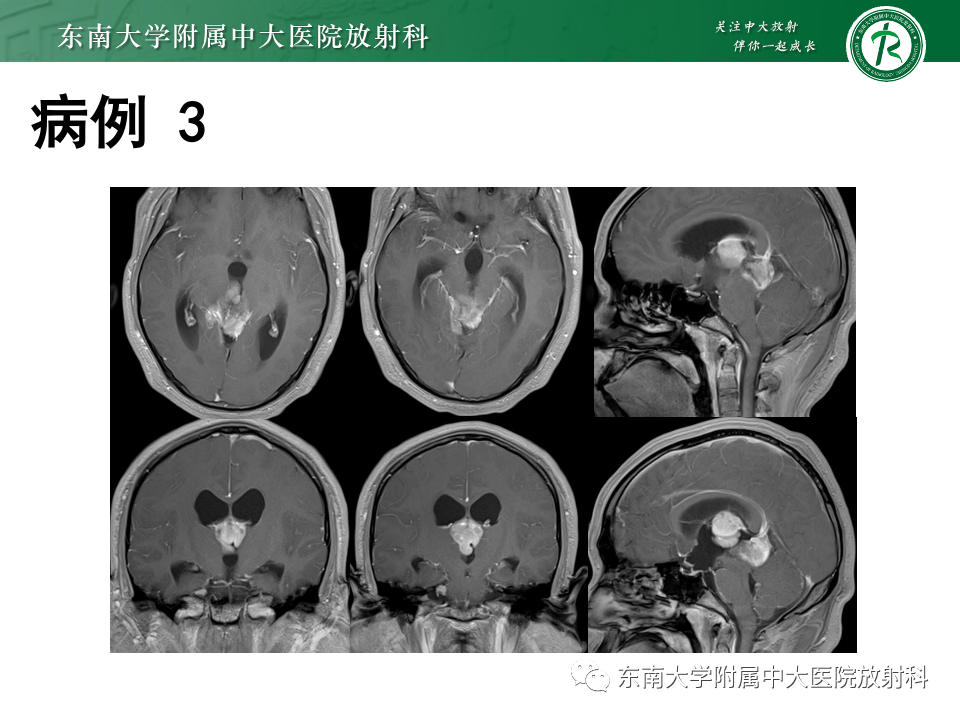 影像PPT - 【PPT】松果体区占位性病变的诊断思路-37