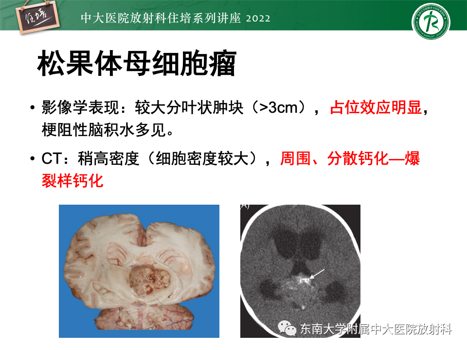 影像PPT - 【PPT】松果体区占位性病变的诊断思路-41