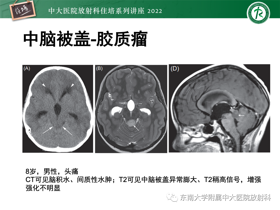 影像PPT - 【PPT】松果体区占位性病变的诊断思路-45