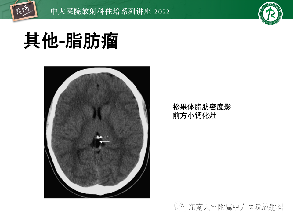 影像PPT - 【PPT】松果体区占位性病变的诊断思路-47
