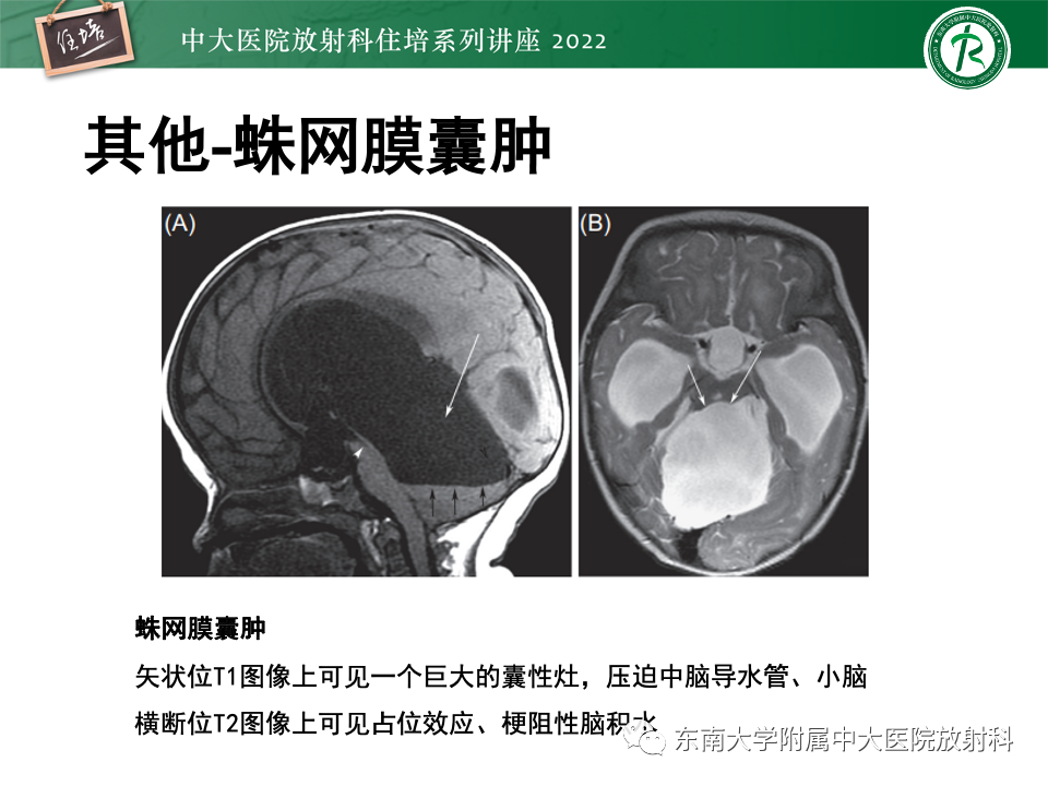 影像PPT - 【PPT】松果体区占位性病变的诊断思路-46