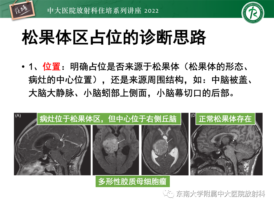 影像PPT - 【PPT】松果体区占位性病变的诊断思路-49