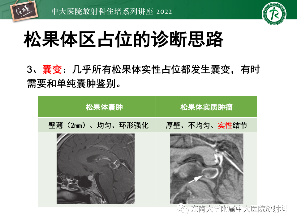 影像PPT - 【PPT】松果体区占位性病变的诊断思路-51