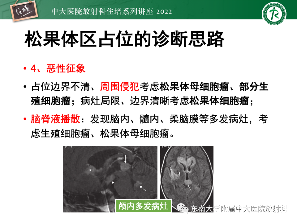 影像PPT - 【PPT】松果体区占位性病变的诊断思路-52