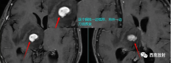 影像PPT - 原发性中枢神经系统淋巴瘤-3 影像PPT - 原发性中枢神经系统淋巴瘤-3