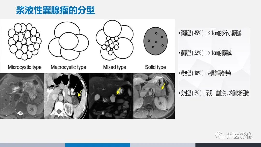 影像PPT - 【PPT】常见胰腺囊性肿瘤-5