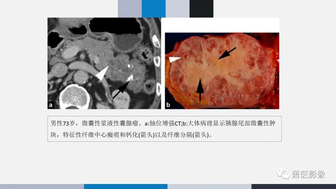 影像PPT - 【PPT】常见胰腺囊性肿瘤-8