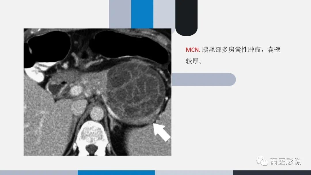 影像PPT - 【PPT】常见胰腺囊性肿瘤-10