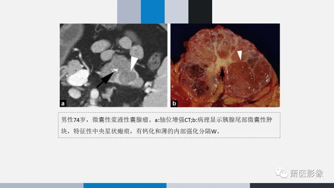 影像PPT - 【PPT】常见胰腺囊性肿瘤-7