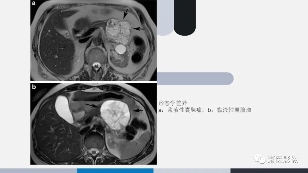 影像PPT - 【PPT】常见胰腺囊性肿瘤-12