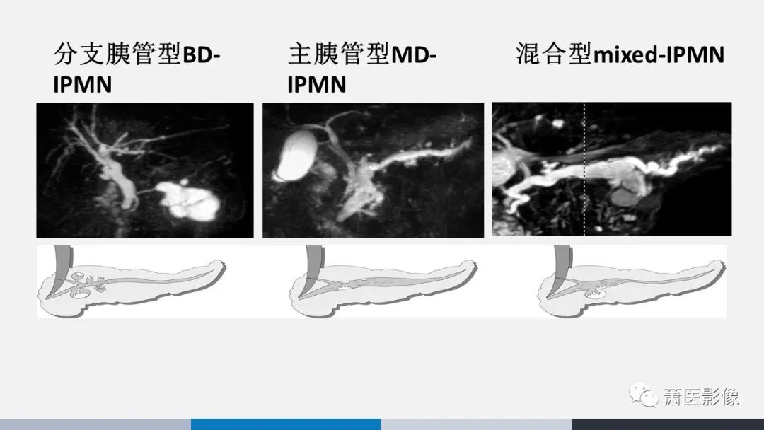 影像PPT - 【PPT】常见胰腺囊性肿瘤-18