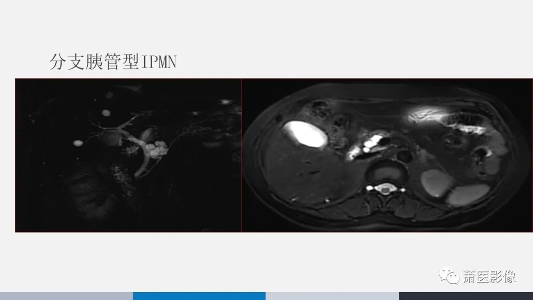 影像PPT - 【PPT】常见胰腺囊性肿瘤-21