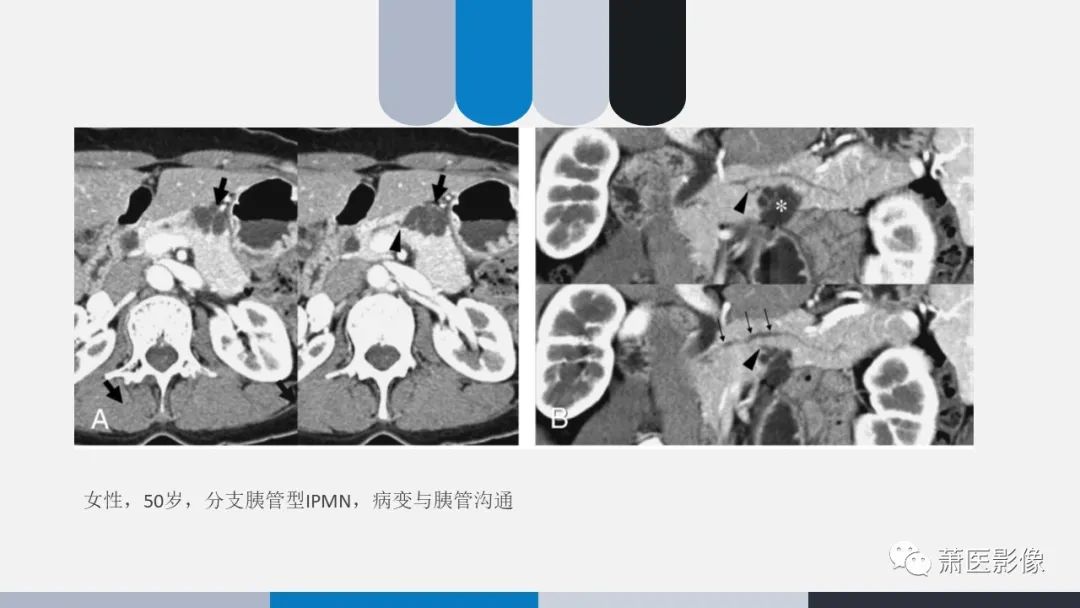 影像PPT - 【PPT】常见胰腺囊性肿瘤-23