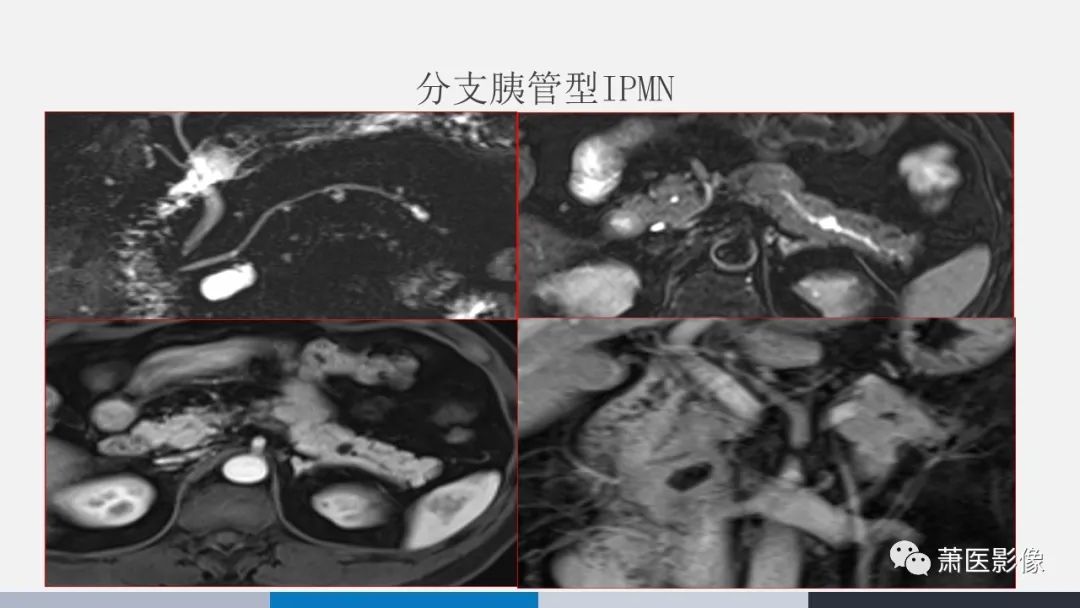 影像PPT - 【PPT】常见胰腺囊性肿瘤-22