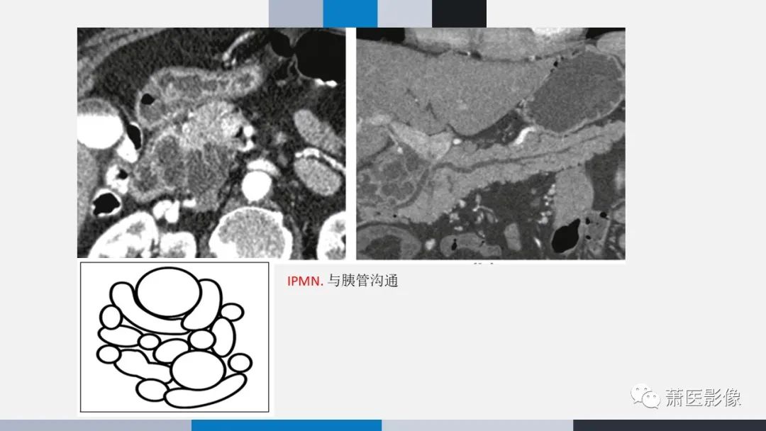 影像PPT - 【PPT】常见胰腺囊性肿瘤-25