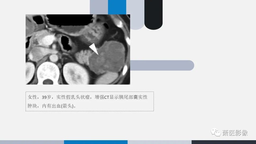 影像PPT - 【PPT】常见胰腺囊性肿瘤-32
