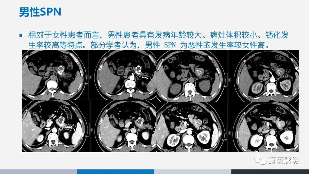 影像PPT - 【PPT】常见胰腺囊性肿瘤-33