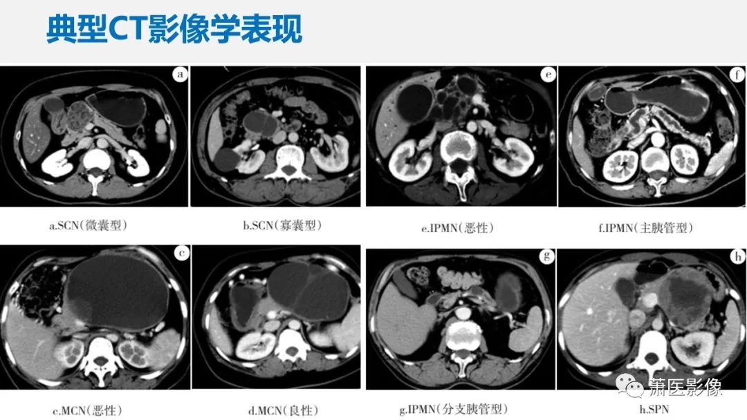 影像PPT - 【PPT】常见胰腺囊性肿瘤-35