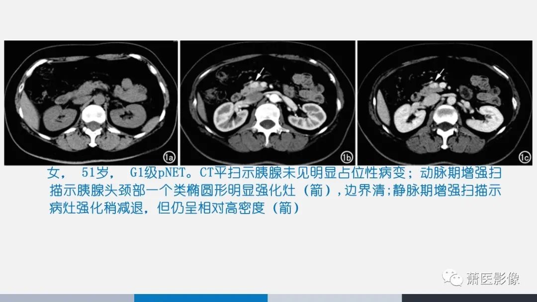 影像PPT - 【PPT】常见胰腺囊性肿瘤-40