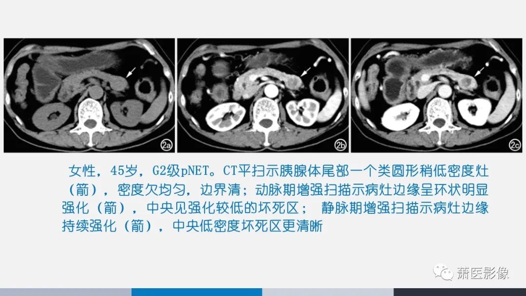 影像PPT - 【PPT】常见胰腺囊性肿瘤-41