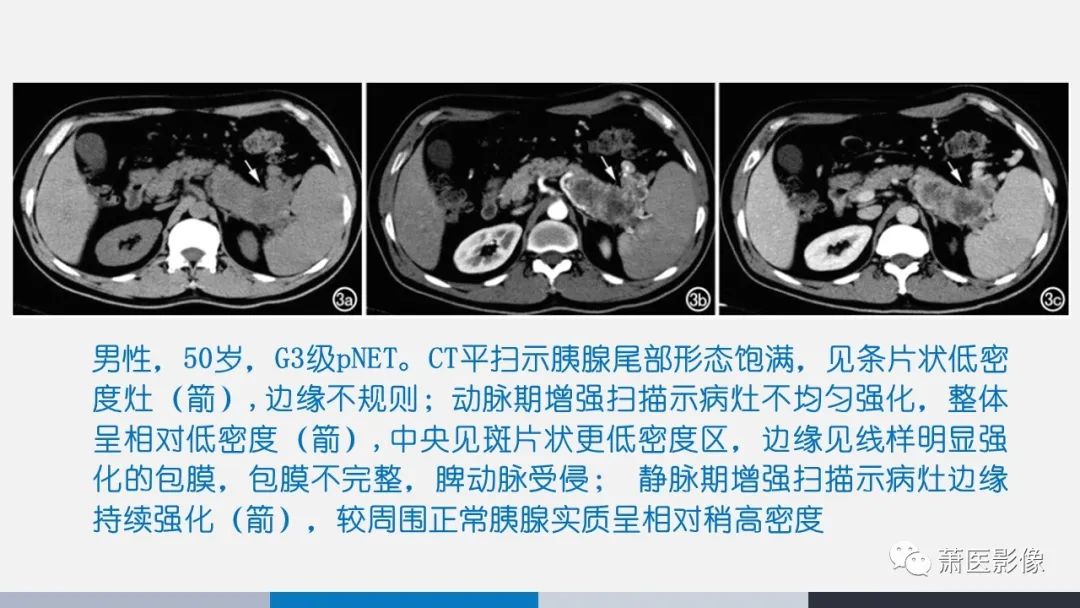 影像PPT - 【PPT】常见胰腺囊性肿瘤-42
