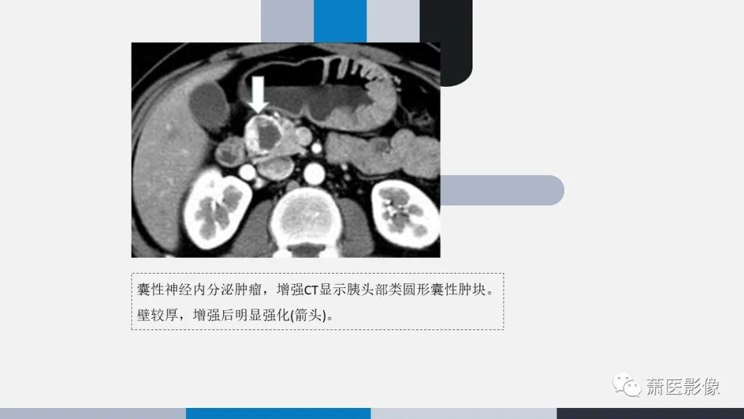 影像PPT - 【PPT】常见胰腺囊性肿瘤-43