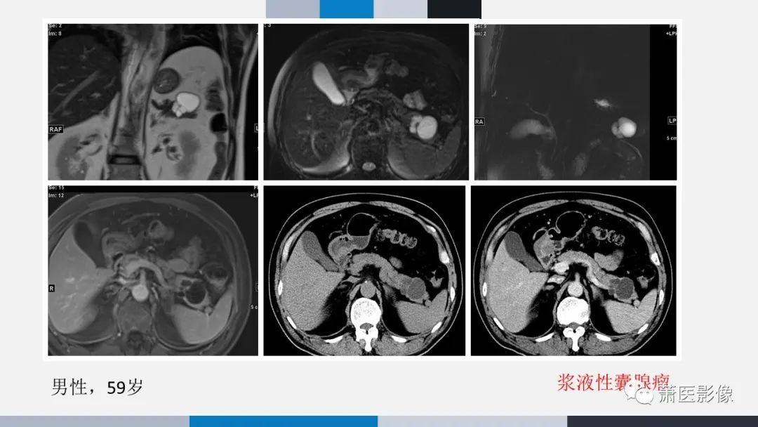 影像PPT - 【PPT】常见胰腺囊性肿瘤-47